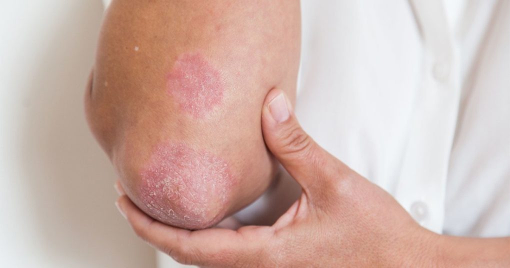 Psoriasis est-il contagieux Découvrez la vérité